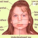 Logo of the podcast Fetal Alcohol Syndrome (FAS) Podcast Fetal Alcohol Syndrome (FAS)