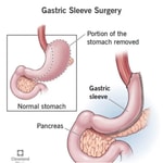 Logo of the podcast Living with a gastric sleeve Podcast Living with a gastric sleeve