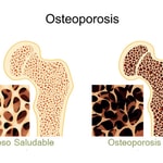 Logo of the podcast OSTEOPOROSIS Podcast OSTEOPOROSIS